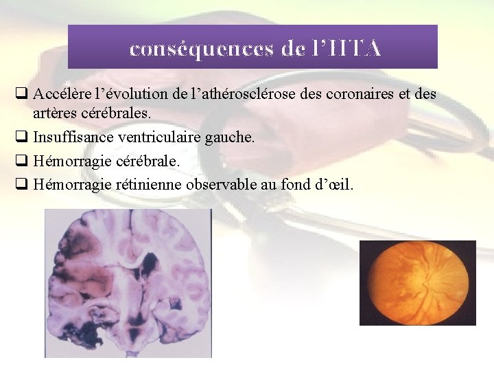  conséquences de l’HTA q Accélère l’évolution de l’athérosclérose des coronaires et des artères