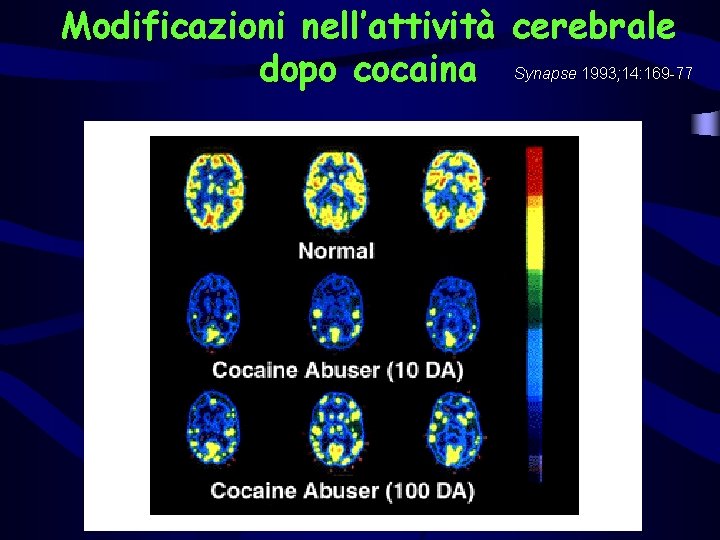 Modificazioni nell’attività cerebrale dopo cocaina Synapse 1993; 14: 169 -77 
