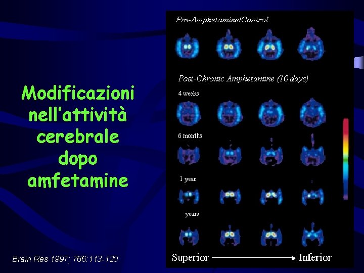 Modificazioni nell’attività cerebrale dopo amfetamine Brain Res 1997; 766: 113 -120 