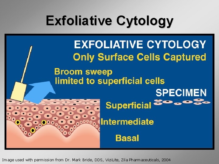 Exfoliative Cytology Image used with permission from Dr. Mark Bride, DDS, Vizi. Lite, Zila