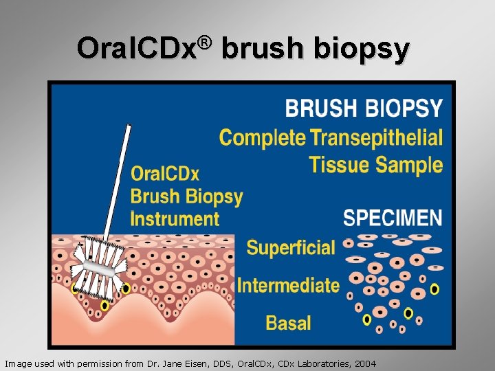 Oral. CDx® brush biopsy Image used with permission from Dr. Jane Eisen, DDS, Oral.