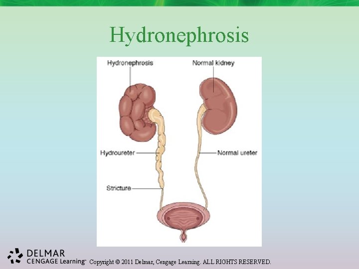 Hydronephrosis Copyright © 2011 Delmar, Cengage Learning. ALL RIGHTS RESERVED. 