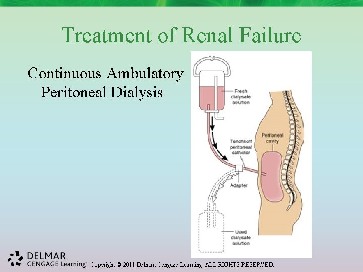 Treatment of Renal Failure Continuous Ambulatory Peritoneal Dialysis Copyright © 2011 Delmar, Cengage Learning.