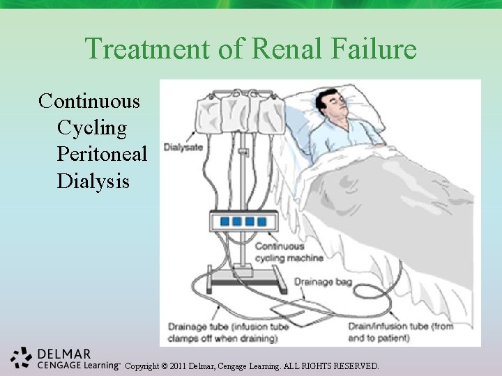 Treatment of Renal Failure Continuous Cycling Peritoneal Dialysis Copyright © 2011 Delmar, Cengage Learning.