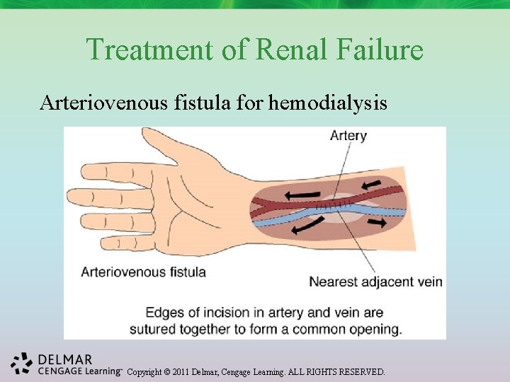 Treatment of Renal Failure Arteriovenous fistula for hemodialysis Copyright © 2011 Delmar, Cengage Learning.