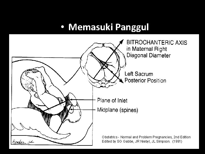 • Memasuki Panggul Obstetrics - Normal and Problem Pregnancies, 2 nd Edition Edited