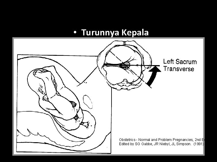  • Turunnya Kepala Obstetrics - Normal and Problem Pregnancies, 2 nd Edition Edited