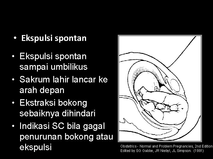  • Ekspulsi spontan sampai umbilikus • Sakrum lahir lancar ke arah depan •