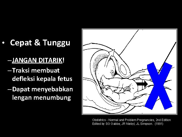  • Cepat & Tunggu – JANGAN DITARIK! – Traksi membuat defleksi kepala fetus