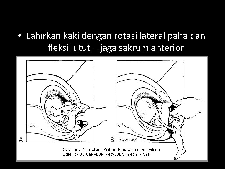  • Lahirkan kaki dengan rotasi lateral paha dan fleksi lutut – jaga sakrum