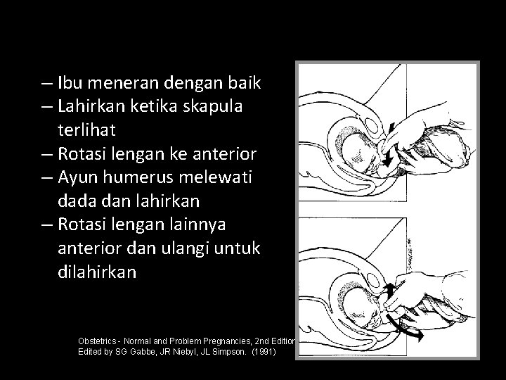 – Ibu meneran dengan baik – Lahirkan ketika skapula terlihat – Rotasi lengan ke