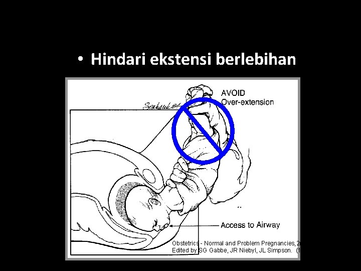  • Hindari ekstensi berlebihan Obstetrics - Normal and Problem Pregnancies, 2 nd Edition