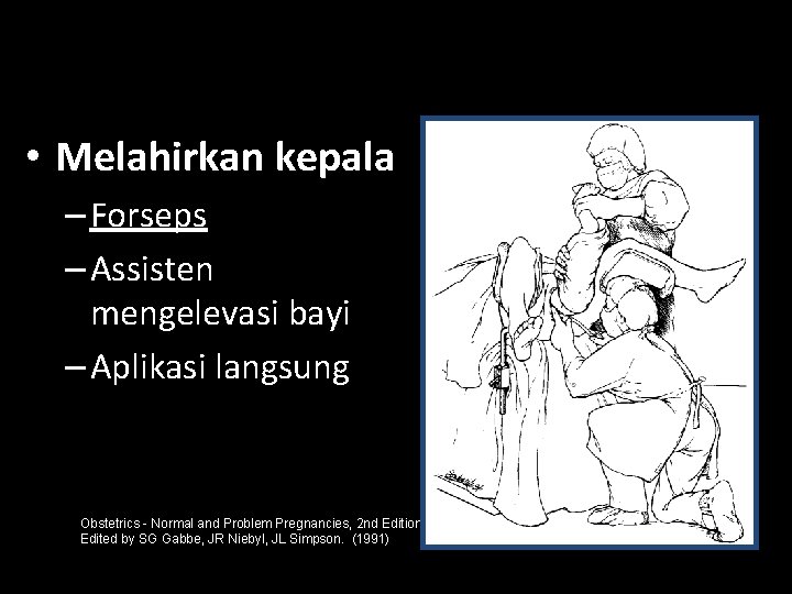  • Melahirkan kepala – Forseps – Assisten mengelevasi bayi – Aplikasi langsung Obstetrics