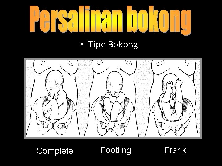  • Tipe Bokong Complete Footling Frank 