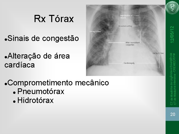 Sinais de congestão Alteração de área cardíaca Comprometimento mecânico Pneumotórax Hidrotórax CT de Medicina