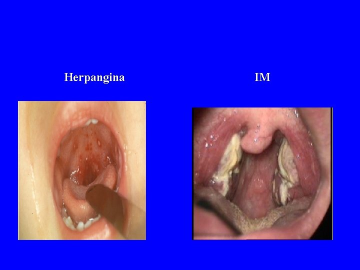 Herpangina IM 