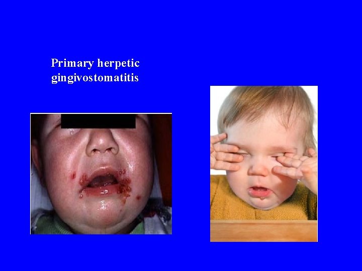 Primary herpetic gingivostomatitis 