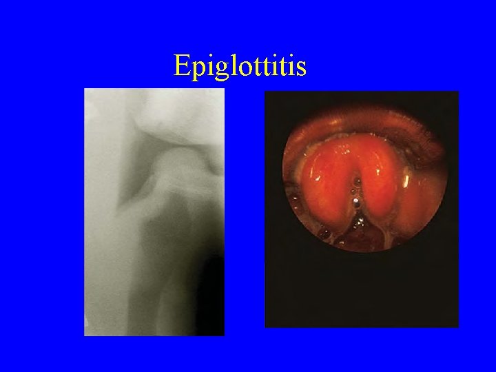 Epiglottitis 