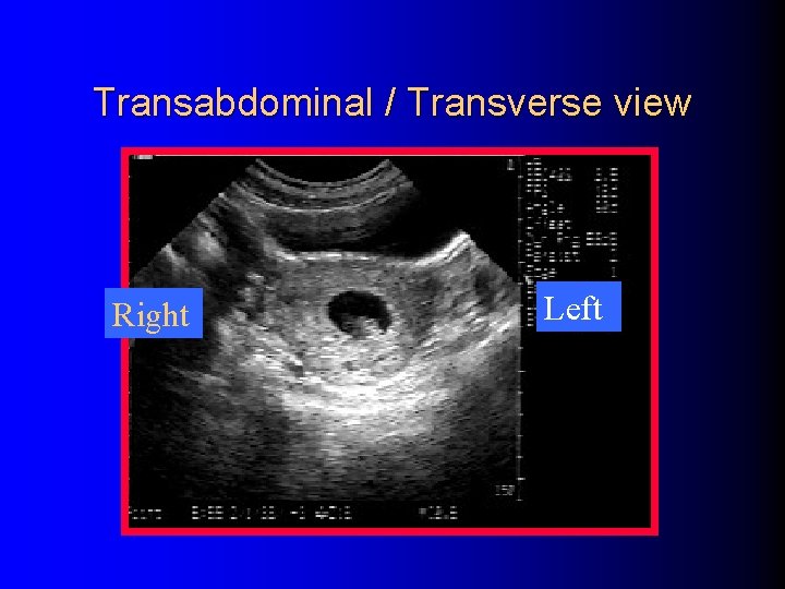 Transabdominal / Transverse view Right Left 