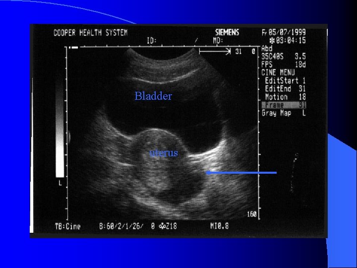 Bladder uterus 