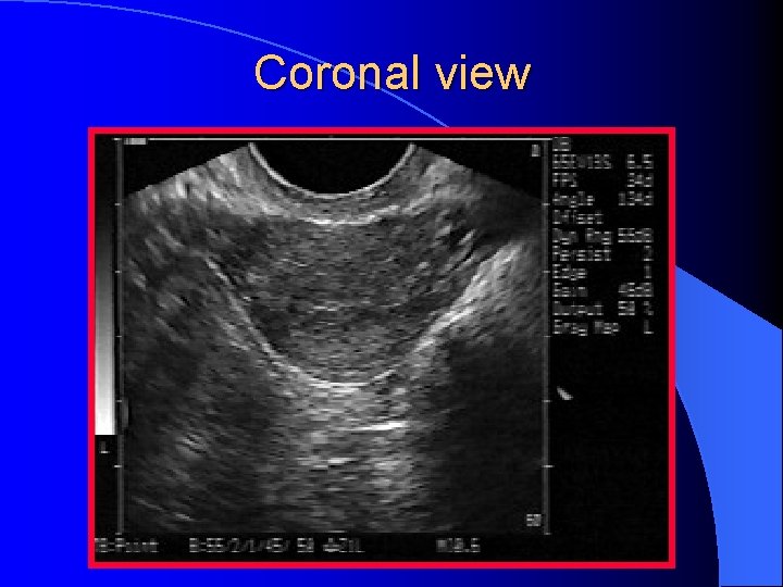 Coronal view 