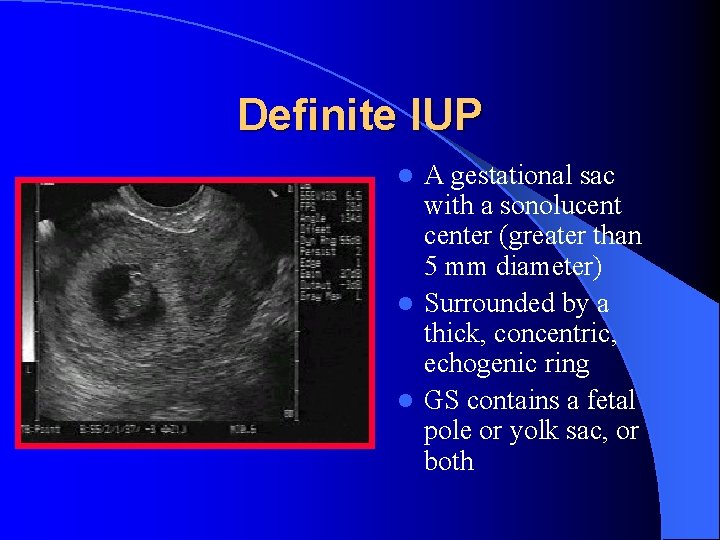 Definite IUP A gestational sac with a sonolucenter (greater than 5 mm diameter) l