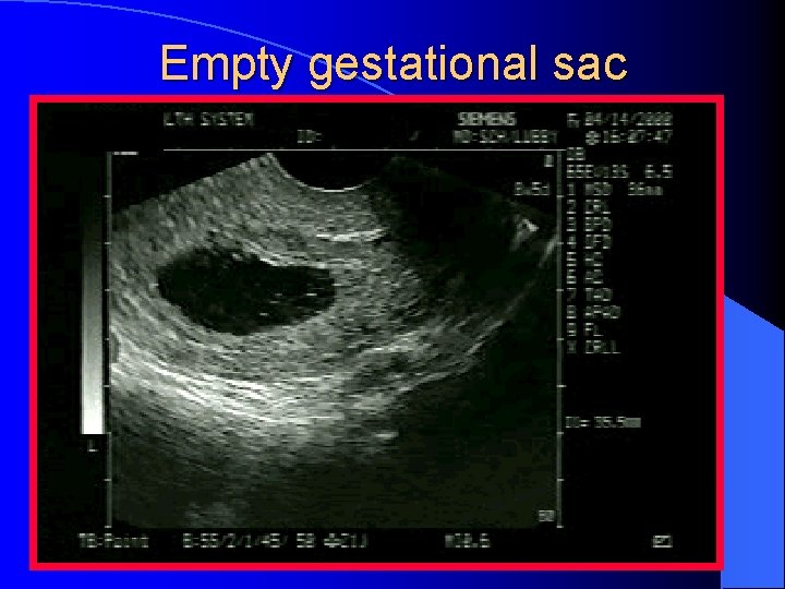 Empty gestational sac 