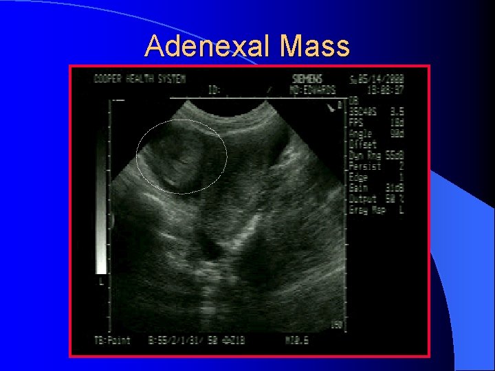 Adenexal Mass 