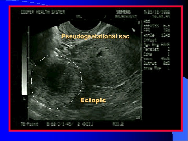 Pseudogestational sac Ectopic 