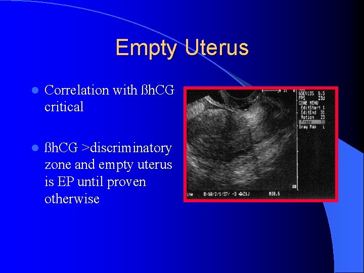 Empty Uterus l Correlation with ßh. CG critical l ßh. CG >discriminatory zone and