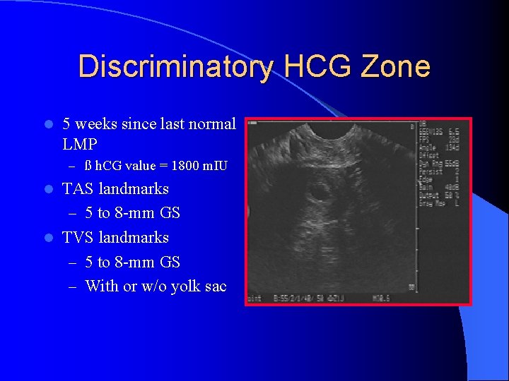 Discriminatory HCG Zone l 5 weeks since last normal LMP – ß h. CG