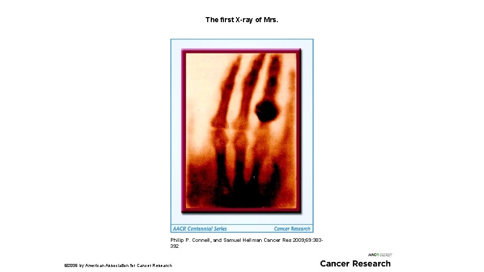 The first X-ray of Mrs. Philip P. Connell, and Samuel Hellman Cancer Res 2009;