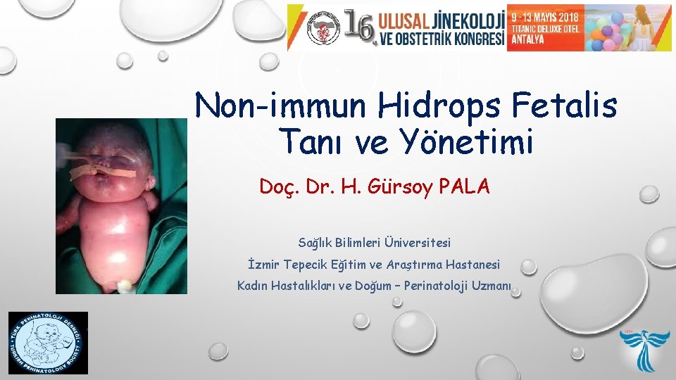 Non-immun Hidrops Fetalis Tanı ve Yönetimi Doç. Dr. H. Gürsoy PALA Sağlık Bilimleri Üniversitesi Non-immun Hidrops Fetalis Tanı ve Yönetimi Doç. Dr. H. Gürsoy PALA Sağlık Bilimleri Üniversitesi