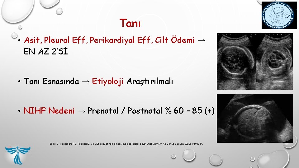 Tanı • Asit, Pleural Eff, Perikardiyal Eff, Cilt Ödemi → EN AZ 2’Sİ • Tanı • Asit, Pleural Eff, Perikardiyal Eff, Cilt Ödemi → EN AZ 2’Sİ •