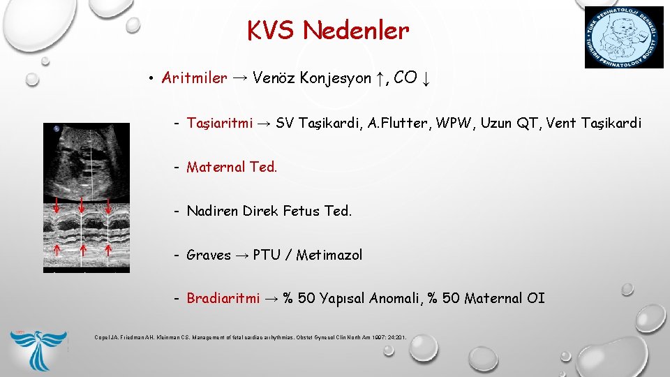 KVS Nedenler • Aritmiler → Venöz Konjesyon ↑, CO ↓ - Taşiaritmi → SV KVS Nedenler • Aritmiler → Venöz Konjesyon ↑, CO ↓ - Taşiaritmi → SV