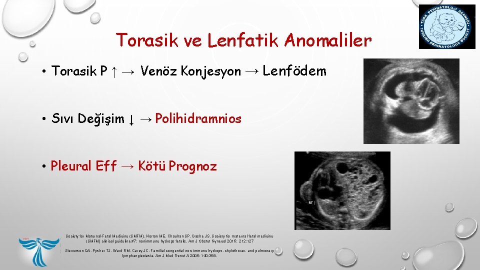 Torasik ve Lenfatik Anomaliler • Torasik P ↑ → Venöz Konjesyon → Lenfödem • Torasik ve Lenfatik Anomaliler • Torasik P ↑ → Venöz Konjesyon → Lenfödem •