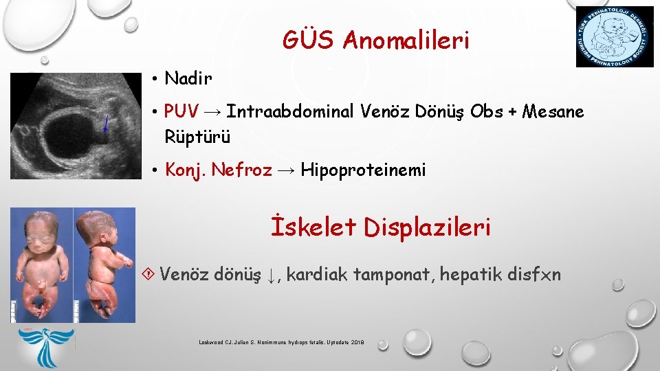 GÜS Anomalileri • Nadir • PUV → Intraabdominal Venöz Dönüş Obs + Mesane Rüptürü GÜS Anomalileri • Nadir • PUV → Intraabdominal Venöz Dönüş Obs + Mesane Rüptürü