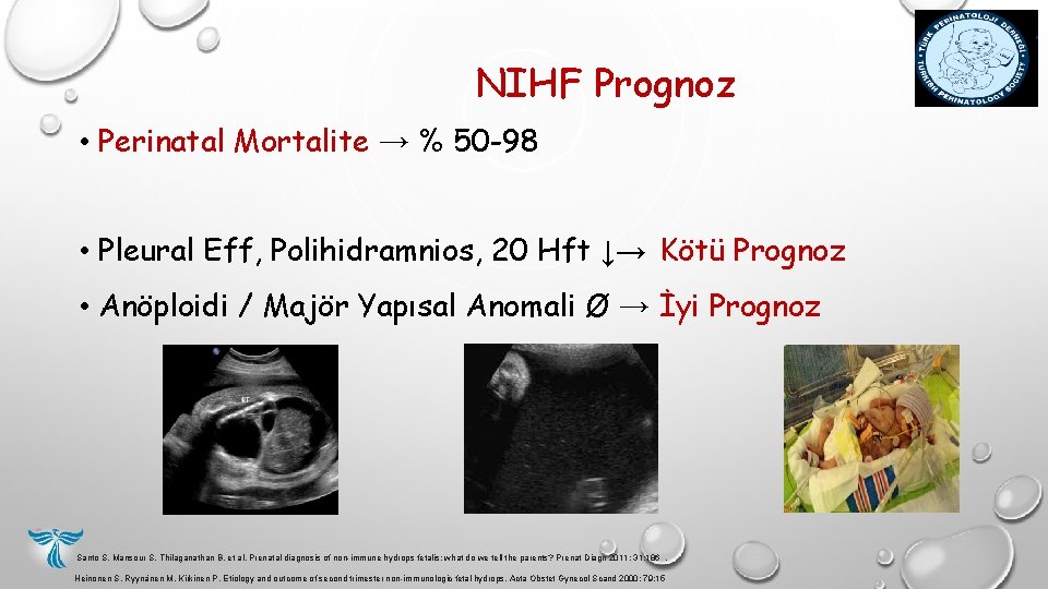 NIHF Prognoz • Perinatal Mortalite → % 50 -98 • Pleural Eff, Polihidramnios, 20 NIHF Prognoz • Perinatal Mortalite → % 50 -98 • Pleural Eff, Polihidramnios, 20
