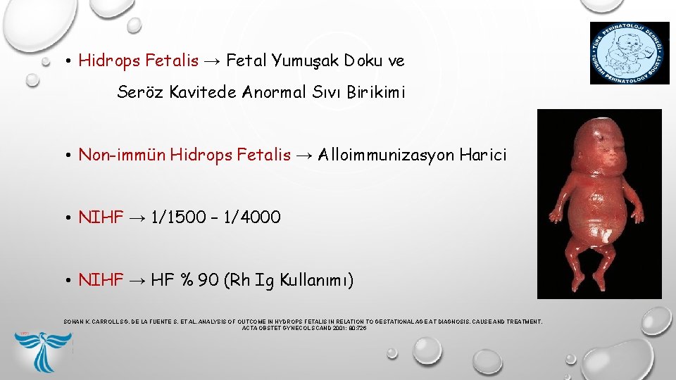 • Hidrops Fetalis → Fetal Yumuşak Doku ve Seröz Kavitede Anormal Sıvı Birikimi • Hidrops Fetalis → Fetal Yumuşak Doku ve Seröz Kavitede Anormal Sıvı Birikimi