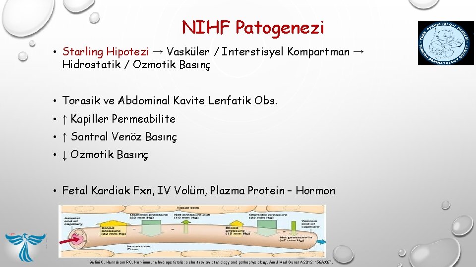 NIHF Patogenezi • Starling Hipotezi → Vasküler / Interstisyel Kompartman → Hidrostatik / Ozmotik NIHF Patogenezi • Starling Hipotezi → Vasküler / Interstisyel Kompartman → Hidrostatik / Ozmotik