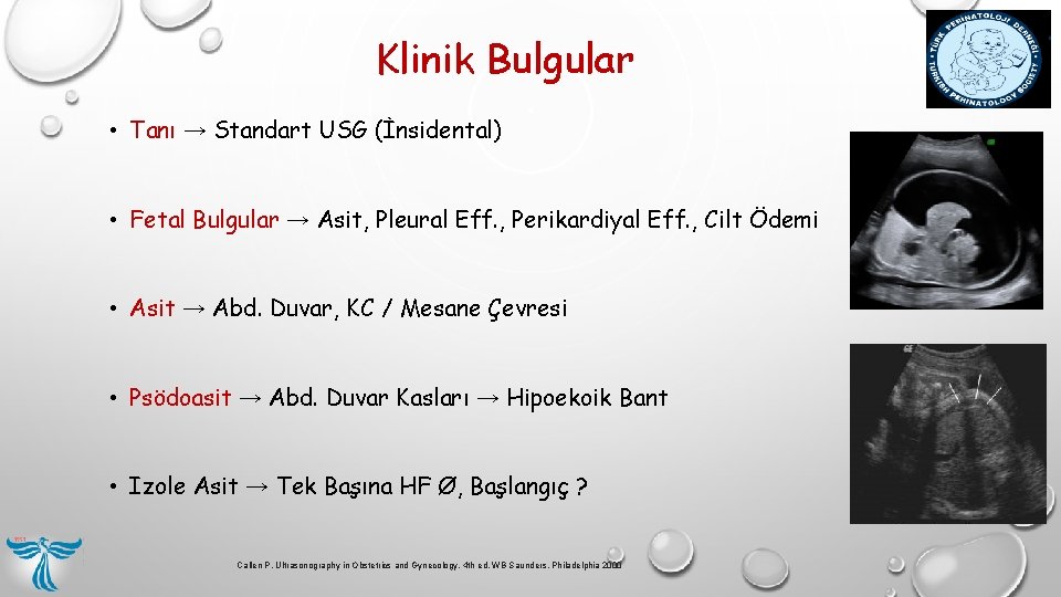 Klinik Bulgular • Tanı → Standart USG (İnsidental) • Fetal Bulgular → Asit, Pleural Klinik Bulgular • Tanı → Standart USG (İnsidental) • Fetal Bulgular → Asit, Pleural