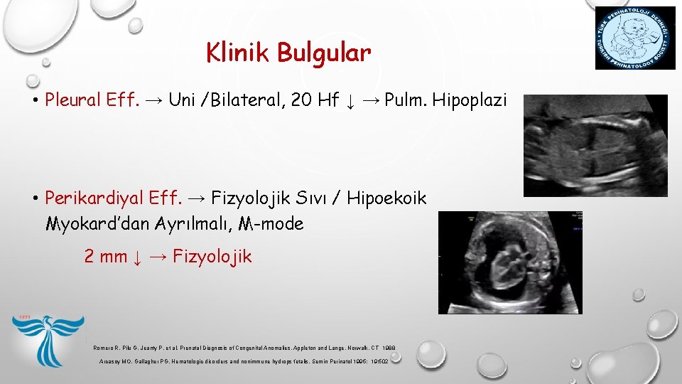 Klinik Bulgular • Pleural Eff. → Uni /Bilateral, 20 Hf ↓ → Pulm. Hipoplazi Klinik Bulgular • Pleural Eff. → Uni /Bilateral, 20 Hf ↓ → Pulm. Hipoplazi