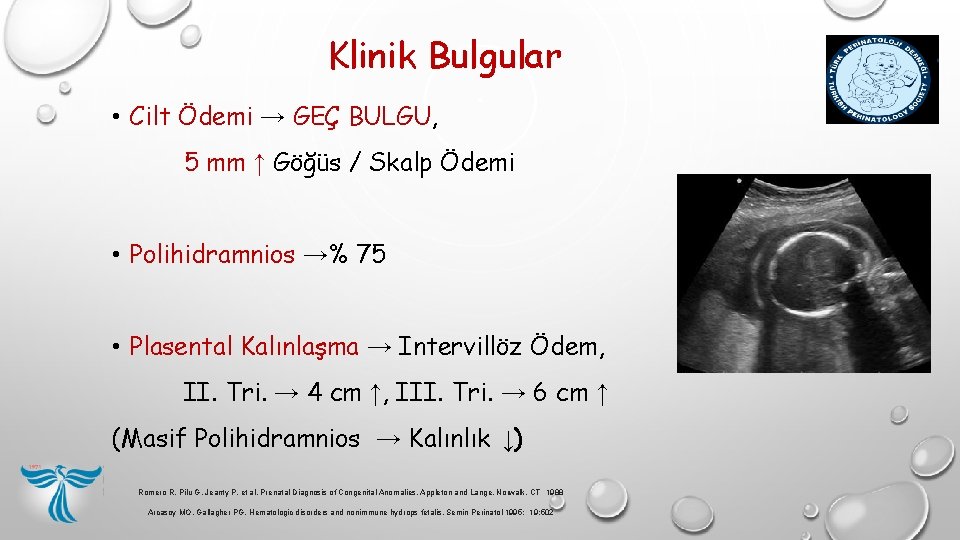 Klinik Bulgular • Cilt Ödemi → GEÇ BULGU, 5 mm ↑ Göğüs / Skalp Klinik Bulgular • Cilt Ödemi → GEÇ BULGU, 5 mm ↑ Göğüs / Skalp