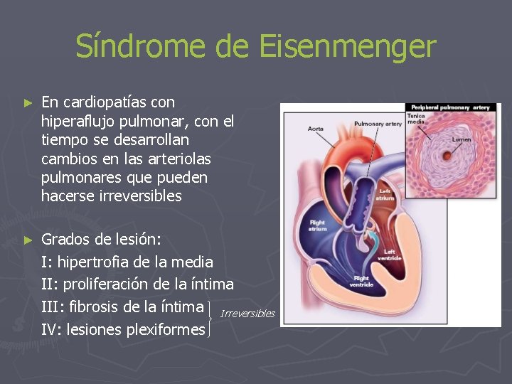 Síndrome de Eisenmenger ► En cardiopatías con hiperaflujo pulmonar, con el tiempo se desarrollan