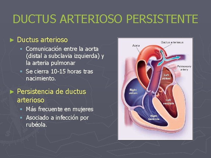 DUCTUS ARTERIOSO PERSISTENTE ► Ductus arterioso § Comunicación entre la aorta (distal a subclavia