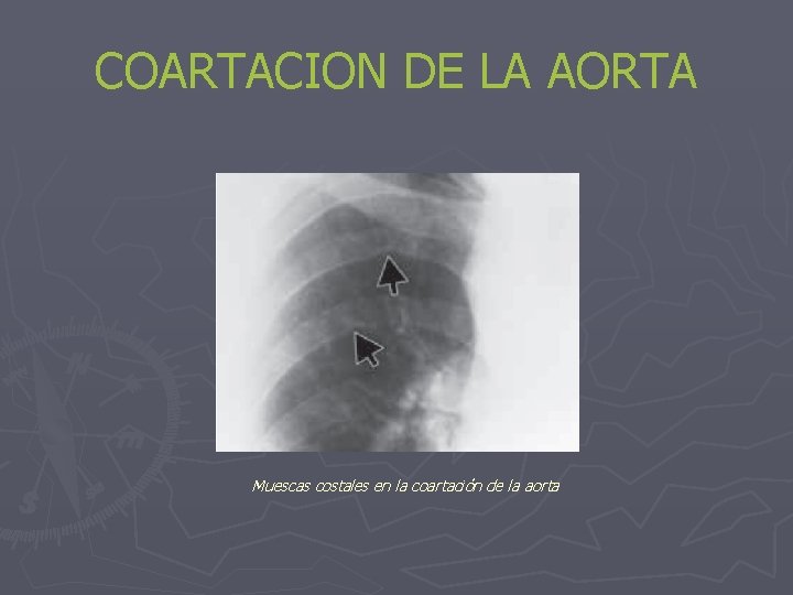 COARTACION DE LA AORTA Muescas costales en la coartación de la aorta 