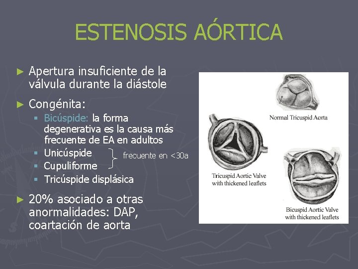 ESTENOSIS AÓRTICA ► Apertura insuficiente de la válvula durante la diástole ► Congénita: §