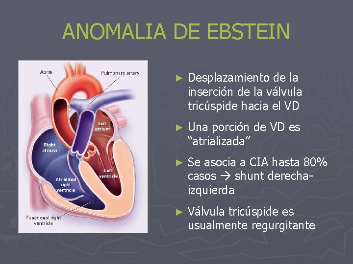 ANOMALIA DE EBSTEIN ► Desplazamiento de la inserción de la válvula tricúspide hacia el