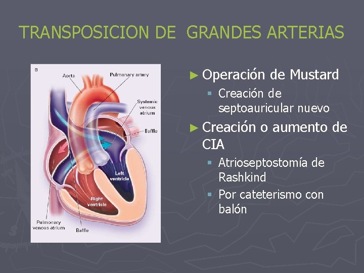 TRANSPOSICION DE GRANDES ARTERIAS ► Operación de Mustard § Creación de septoauricular nuevo ►