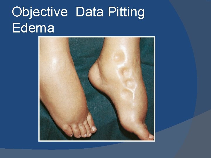 Objective Data Pitting Edema 